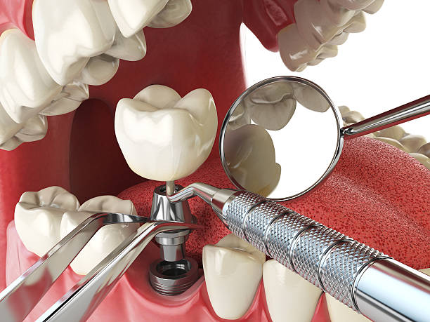 Best Emergency Treatment for Dental Infections or Abscesses in Medina, MN